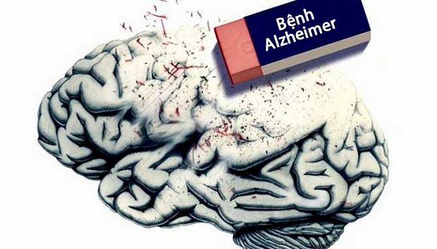 Bệnh Alzheimer là gì & Cách khắc phục, điều bệnh như thế nào?